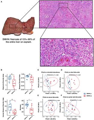 Landscapes of gut microbiome and bile acid signatures and their interaction in HBV-associated acute-on-chronic liver failure